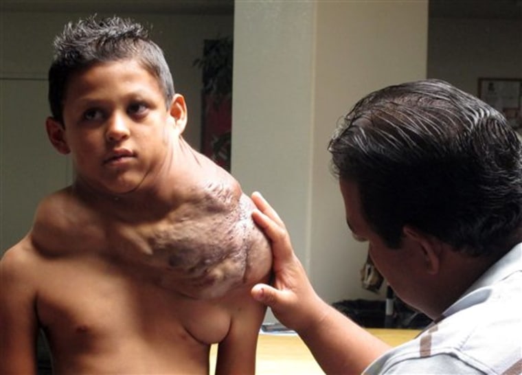 The father of a 9-year-old boy suffering from massive tumor examines his shoulder in Rio Rancho, N.M., on Friday. 